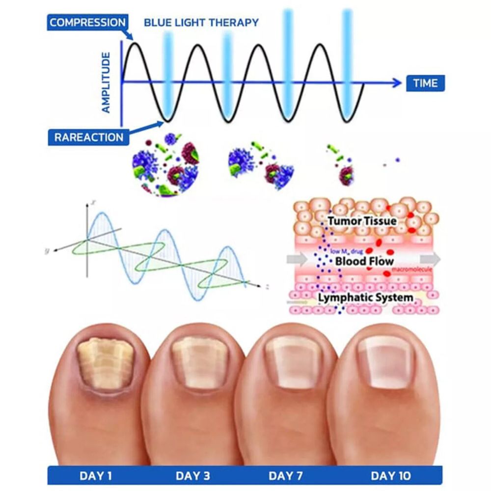 Nail Fungus Removal Therapy Device Treatment Cleaning Laser Toenail Fingernail