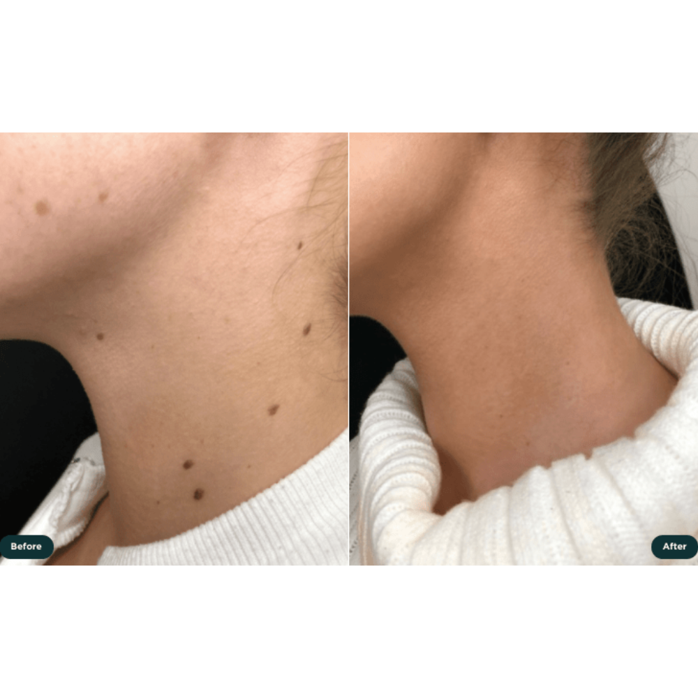 Skin Tag Remover Acne Pimple Patch Removal Facial Care Spot Plaster