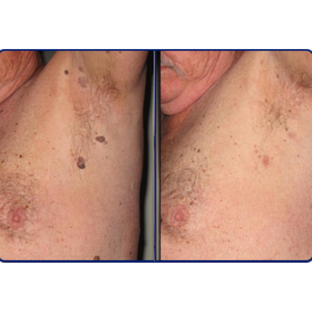 Skin Tag Remover Acne Pimple Patch Removal Facial Care Spot Plaster