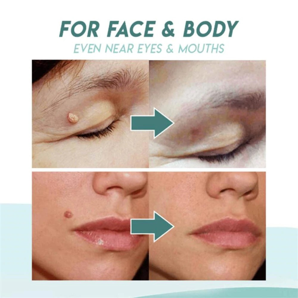 Skin Tag Remover Acne Pimple Patch Removal Facial Care Spot Plaster