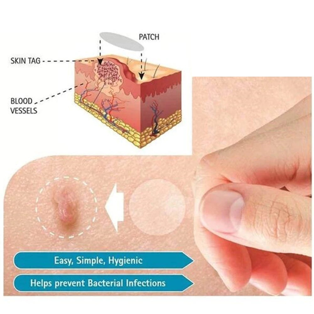 Skin Tag Remover Acne Pimple Patch Removal Facial Care Spot Plaster