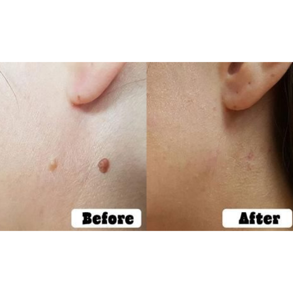 Skin Tag Remover Acne Pimple Patch Removal Facial Care Spot Plaster
