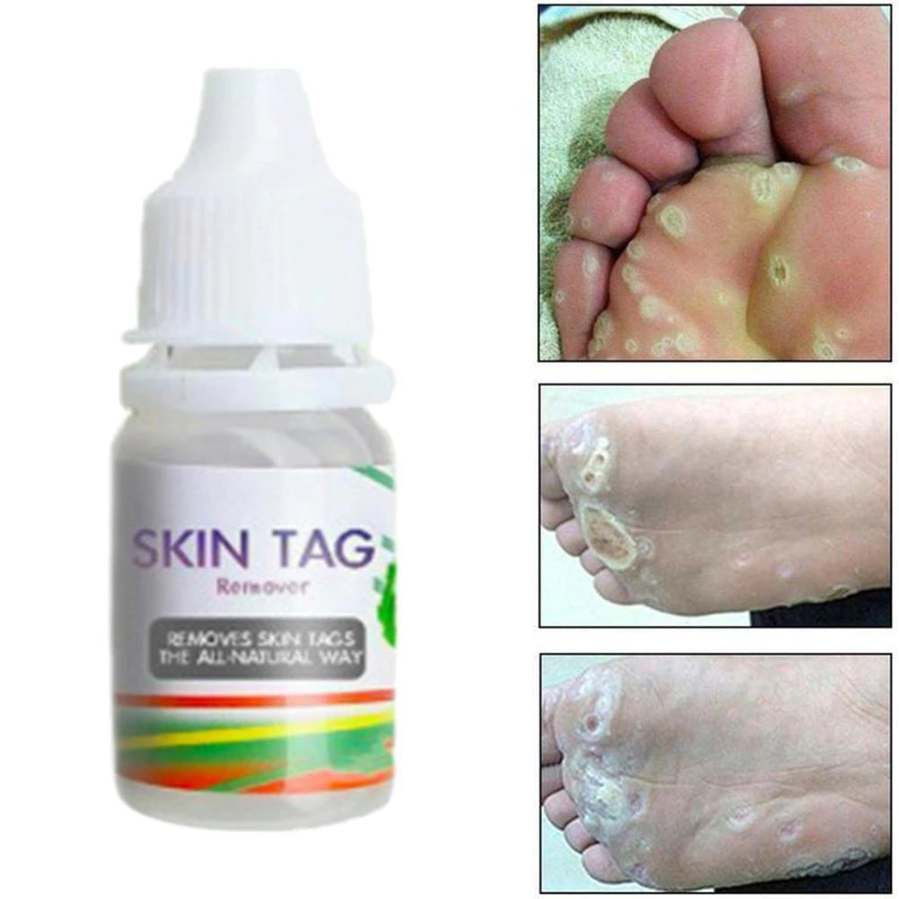 SKIN TAG REMOVER LIQUID MOLE WART ACNE PIMPLE PATCH REMOVAL SPOT SAFE & FAST