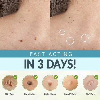 SKIN TAG REMOVER LIQUID MOLE WART ACNE PIMPLE PATCH REMOVAL SPOT SAFE & FAST